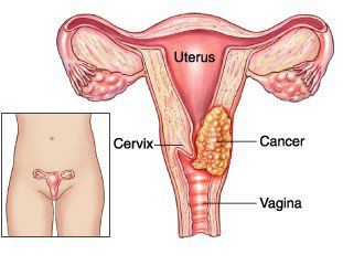 Cervical cancer test with benign cell changes is good or bad?