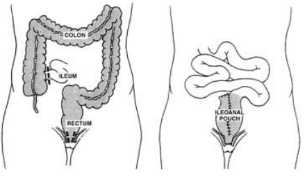 Extraintestinal manifestations of ulcerative colitis with bleeding