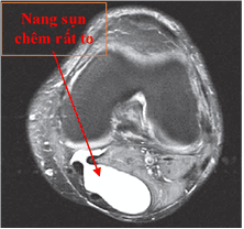 
Kết quả chụp CT khớp gối phát hiện nang sụn chêm
