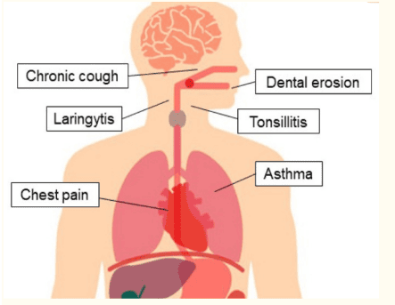 
Các biểu hiện ngoài thực quản của bệnh trào ngược dạ dày thực quản.
