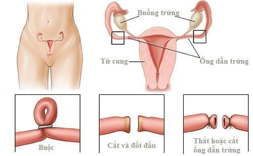 Đã sinh mổ 3 lần và thắt ống dẫn trứng có cách nào sinh con được không?