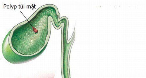 Does 4mm gallbladder polyp affect digestion?