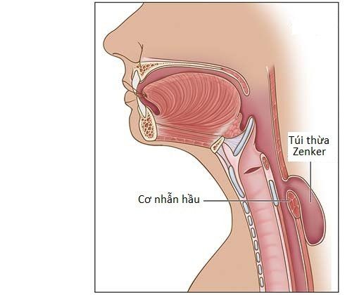 Điều trị Túi thừa Zenker ở thực quản qua nội soi