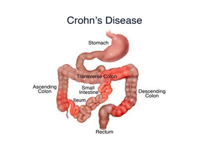 Why is Crohn's disease common among Jews?