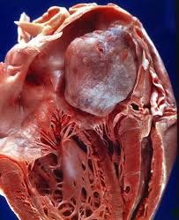 How should atrial mucinous cyst be treated?