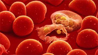 Diagnosis and treatment of infectious mononucleosis