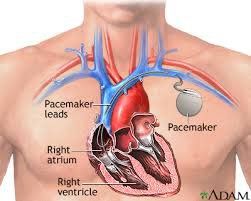 I have a pacemaker, should I donate blood?