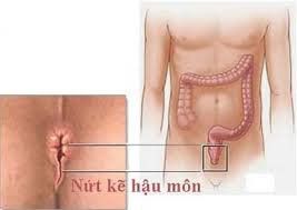 Điều trị tái nứt kẽ hậu môn như thế nào?