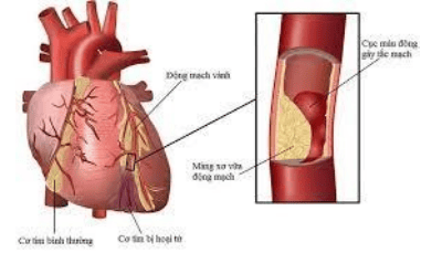 
Mạch máu nuôi cơ tim bị tổn thương là yếu tố chính dẫn đến bệnh mạch vành
