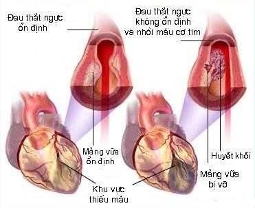 
Bệnh mạch vành là biểu hiện của tình trạng viêm tại chỗ hoặc toàn thân
