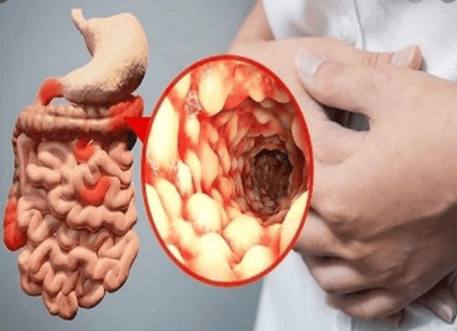 
Bệnh Crohn – bệnh lý ở đường tiêu hoá gây ảnh hưởng đến chất lượng cuộc sống
