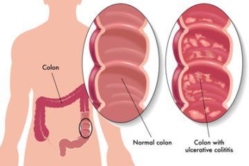History and pathogenesis of Crohn's disease