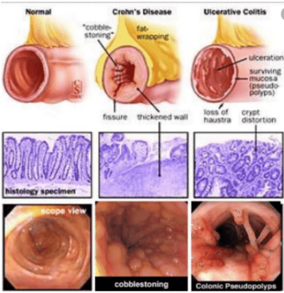 
Bệnh Crohn là một trong các nguyên nhân gây tiêu chảy kéo dài
