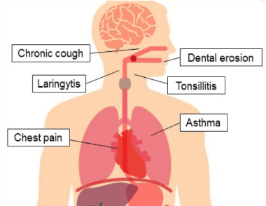 
Các biểu hiện ngoài thực quản của bệnh trào ngược dạ dày thực quản.
