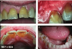 
Bệnh lý khoang miệng do trào ngược dạ dày thực quản
