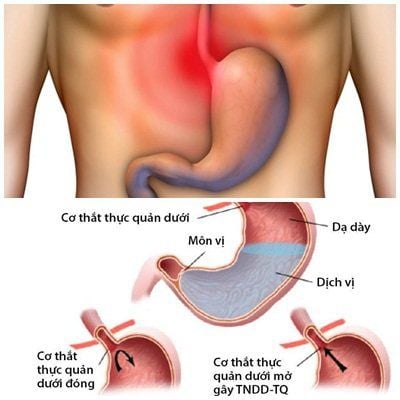 Diseases of the oral cavity due to gastroesophageal reflux