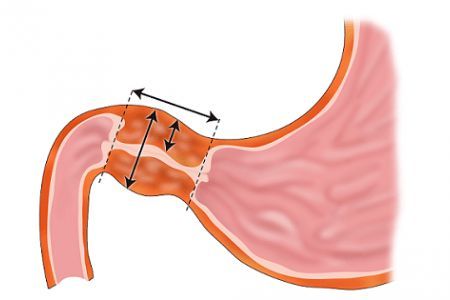 6 biến chứng của bệnh Crohn ảnh hưởng đến cơ thể của bạn