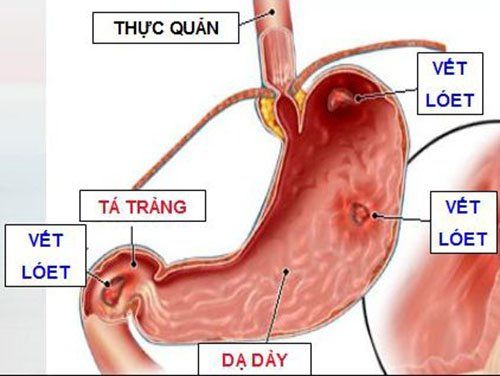 Stomach pain with bloating, abdominal distension, how to treat?