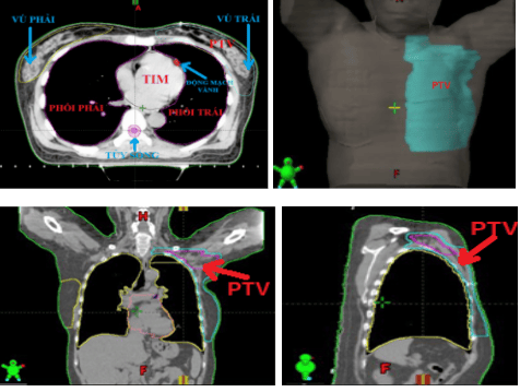 
Hình 2. Xác định các thể tích trong lập kế hoạch xạ trị
