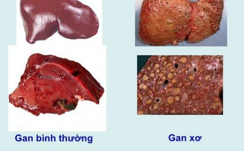 What is CRBC liver parenchyma?