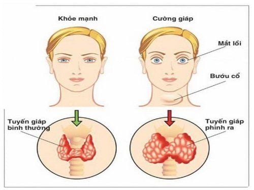 Bướu cổ do thiếu Iốt khi mang thai cần phải chú ý gì?