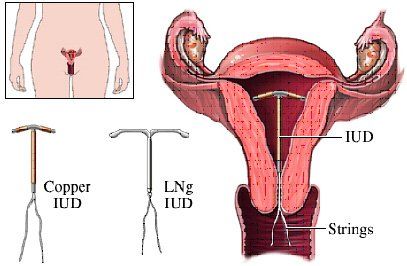 What happens when you remove the IUD?