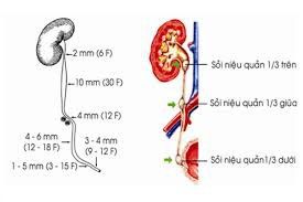 Sỏi niệu quản gần bàng quang 5x15mm uống thuốc tiêu sỏi được không?