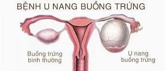 
Khoảng 1/10 phụ nữ sẽ gặp phải tình trạng xuất hiện những nang trứng to chứa đầy dịch trong buồng trứng của họ trong năm đầu tiên sau khi đặt vòng tránh thai
