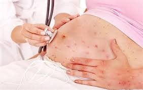 3 tháng đầu thai kỳ mắc rubella có nguy hiểm không?