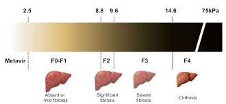 Is liver fibrosis level f3-f4 (13.9kpa) grade 3 cirrhosis or not?