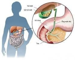 Can 7mm intrahepatic gallstones with digestive disorders be completely cured?