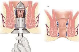 Is there a blood clot in the stool after Longo hemorrhoid surgery?