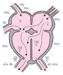 Atrioventricular septal defect in neonates