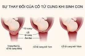 Cổ tử cung mở 2p có cần đến bệnh viện không?