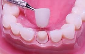 Mài răng và bọc răng sứ cho trẻ 13 tuổi có ảnh hưởng gì đến sau này không?