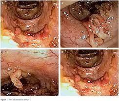 
Hình ảnh giả polyp và sẹo loét cũ trong viêm loét đại tràng chảy máu.
