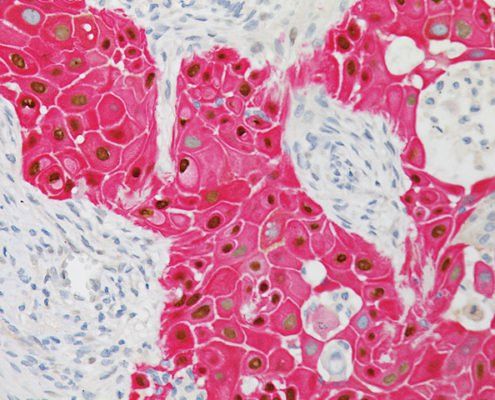 The role of artificial intelligence in early squamous cell cancer detection