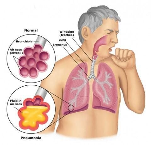 Ung thư phổi có 4 giai đoạn với các triệu chứng đi kèm. 