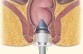 How to treat longo hemorrhoids after 15 days of bleeding in the surgical area?