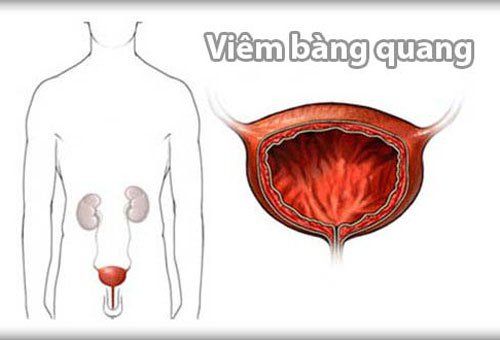 Tiểu máu đau buốt dưới bụng và dương vật có phải viêm tam giác bàng quang?