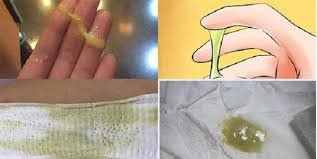 Clumped yellow or green discharge is a sign of what disease?