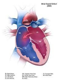 How is an 11-year-old child with atrial heart disease treated?