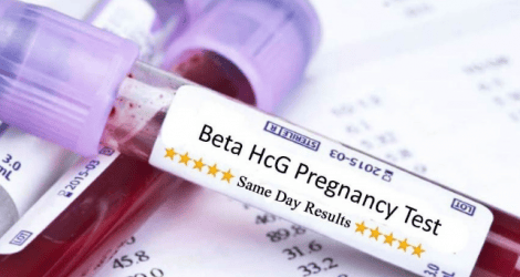 HCG concentration on the 9th day after embryo transfer is 85.46 is it pregnant?