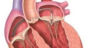 People with diabetes, high blood pressure can treat heart valve stenosis by dilating the heart valve with a percutaneous balloon?