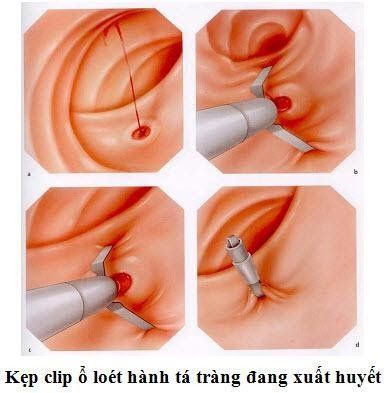 
Chảy máu tái phát sau can thiệp
