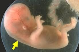 Thai có độ mờ da gáy 2,4mm, xét nghiệm Trisomy 21 là 1:282 có sao không?