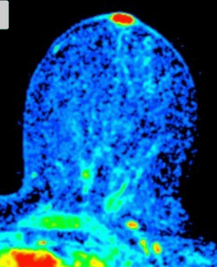 Image of Paget's disease of the breast