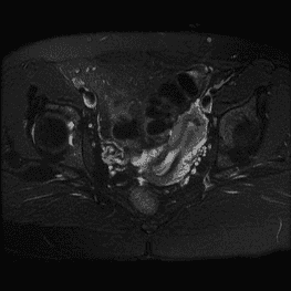 
Hình 3: Hình tử cung một sừng trên MRI
