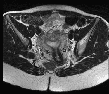 
Hình 3: Hình ảnh tử cung hình cung trên phim MRI
