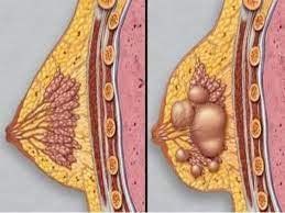 The nipple is swollen like pus, bursting causing pain after treatment of blocked milk ducts is a sign of what disease?